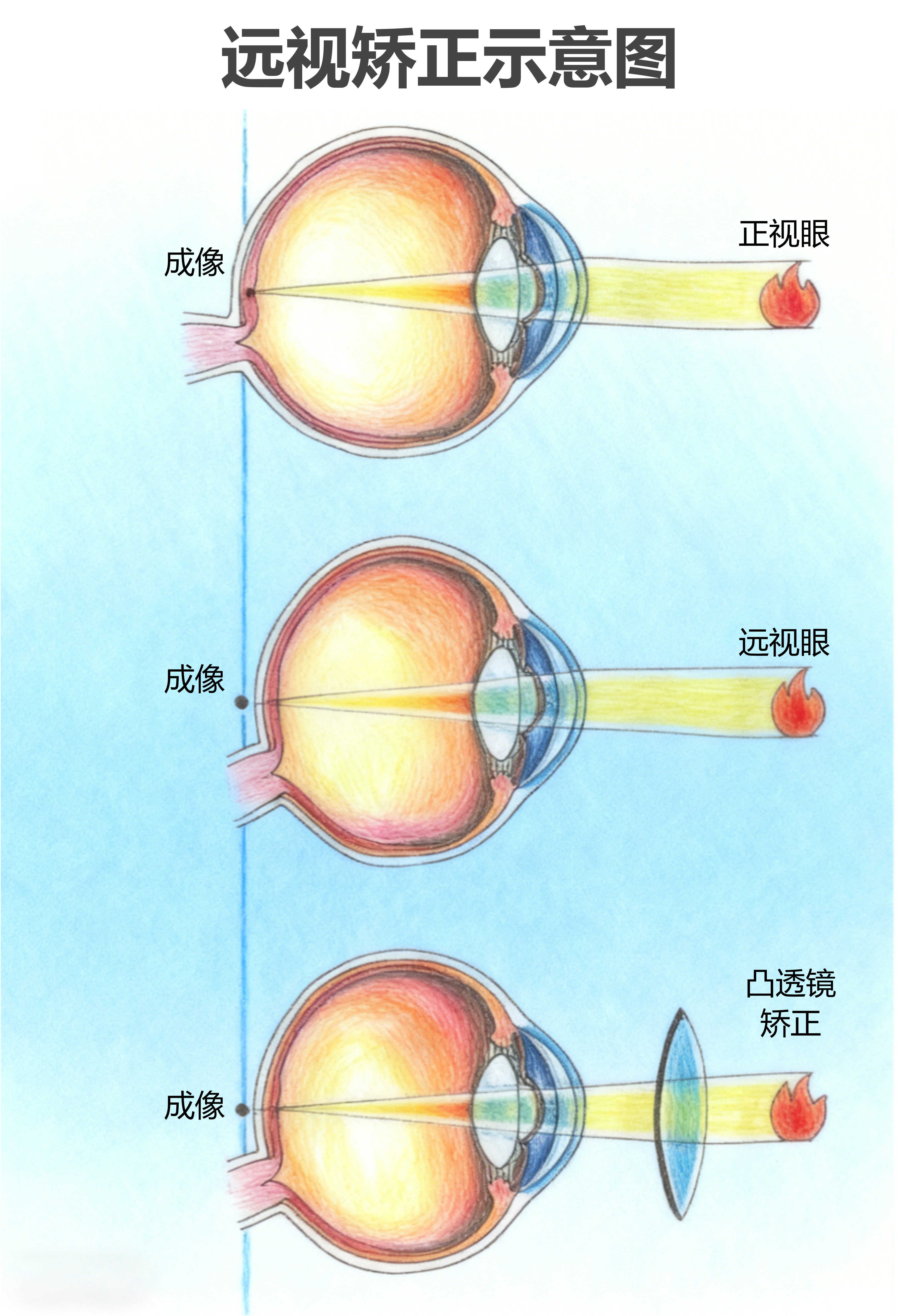 远视矫正示意图：正视眼、远视眼与凸透镜矫正