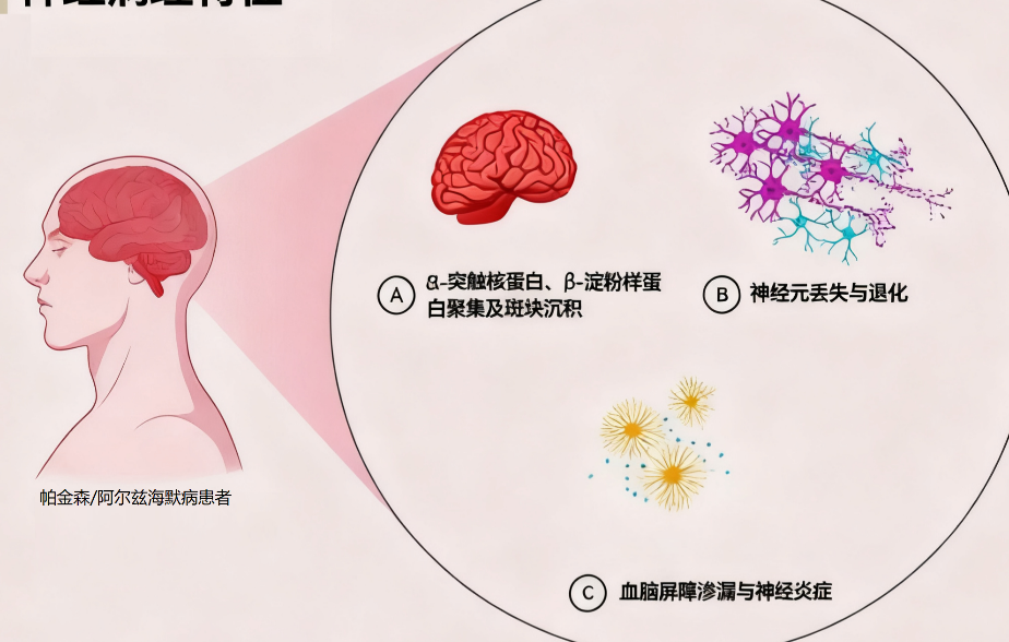 帕金森/阿尔兹海默病病理图