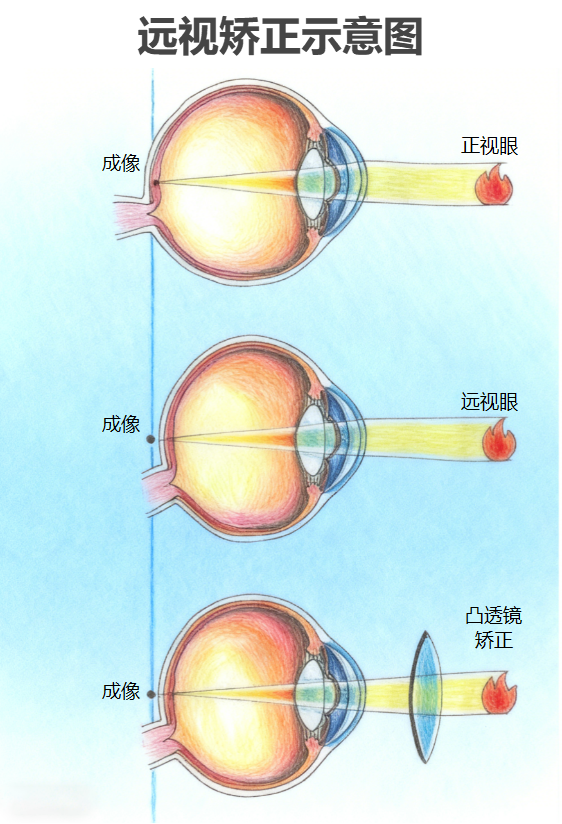远视矫正原理示意图